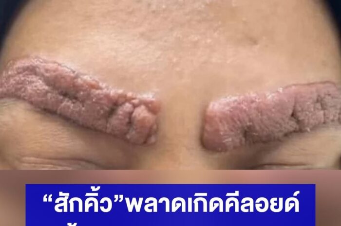 อุทาหรณ์! สักคิ้วพลาดเกิดคีลอยด์-แผลเป็นนูน