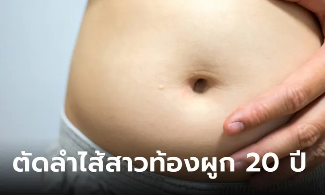 สาววัย 29 ท้องผูกเรื้อรังนาน 20 ปี หมอตัดลำไส้ที่ตายออก ใหญ่ยาวยังกับงูเหลือม